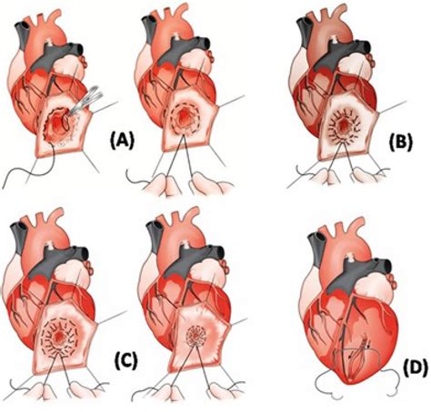 left ventricular aneurysm treatment.